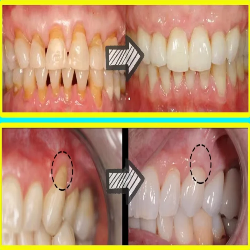Soro de goma para reparação rá - Teeth Whitening Baking Soda avaliação e preço