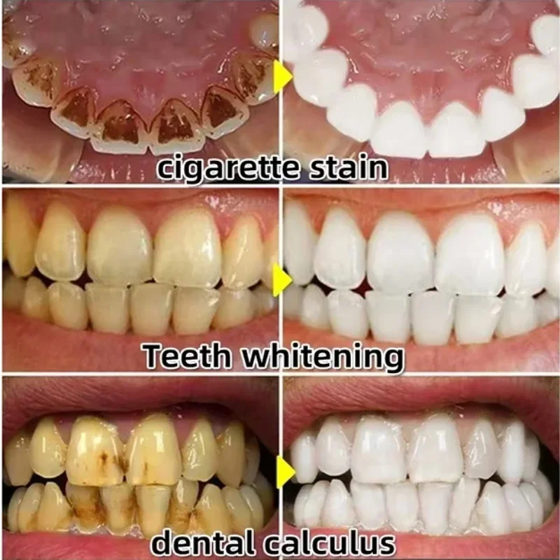 Soro de goma para reparação rá - Teeth Whitening Baking Soda avaliação e preço