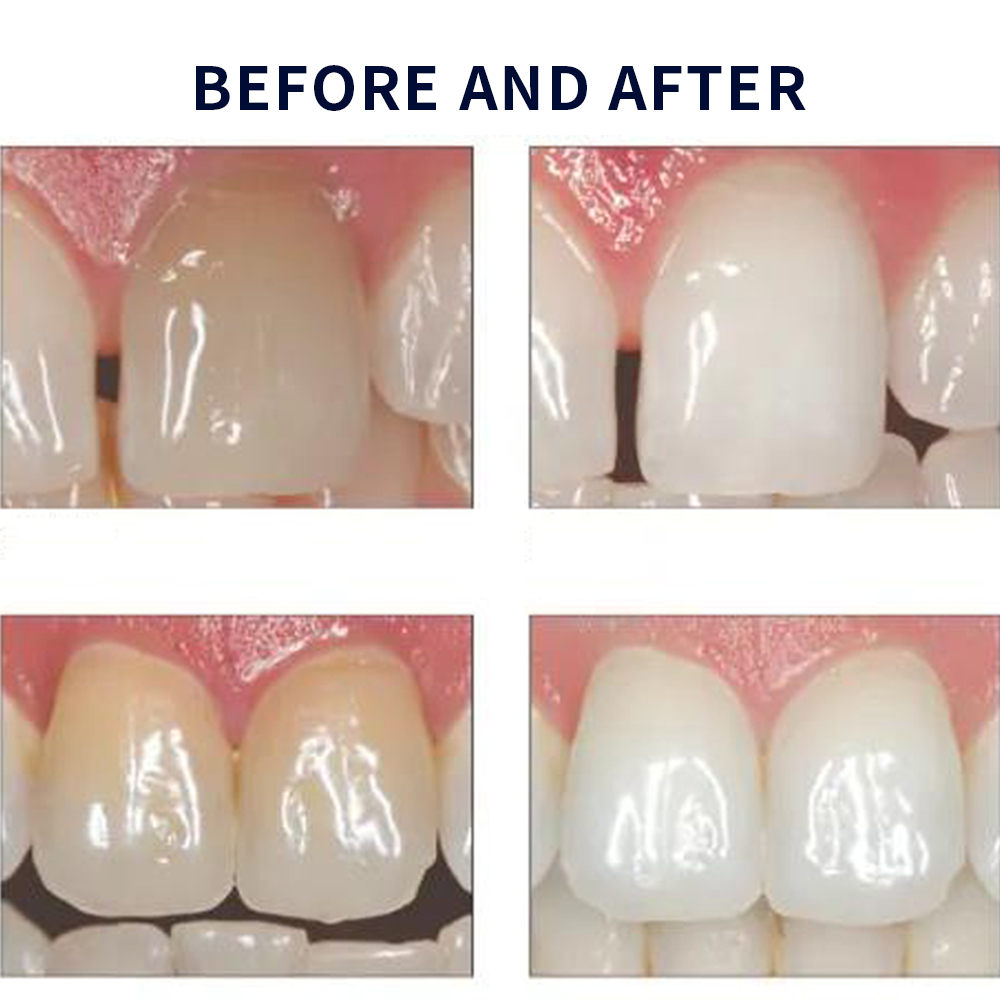 Opalescência Whitening Gel Kit - Teeth Whitening At Home Kit avaliação e preço