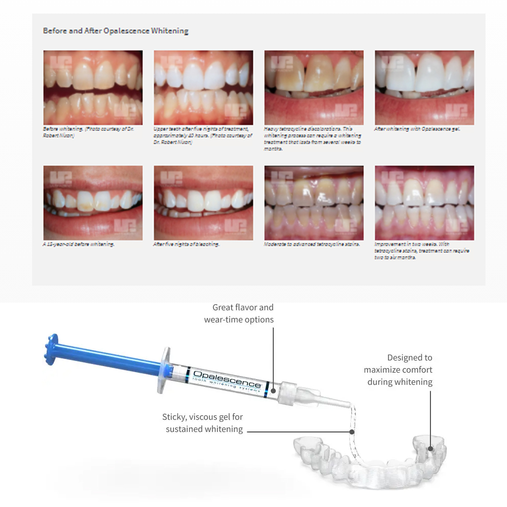 Opalescência Whitening Gel Kit - Teeth Whitening At Home Kit avaliação e preço