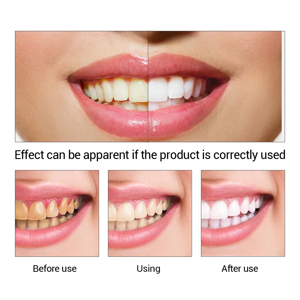FTEENPLY Essência para claream - Teeth Whitening App avaliação e preço