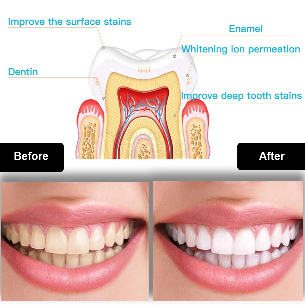 Kit de clareamento dental dos  - Teeth Whitening App avaliação e preço